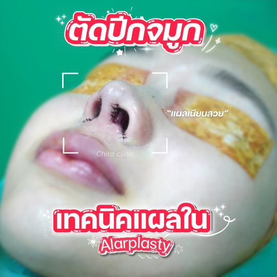 ตัดปีกจมูกใบเฟิร์น ตัดปีกจมูกใบเฟิร์น