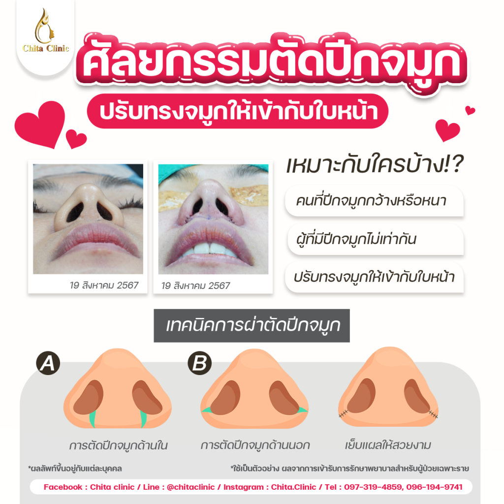 ตัดปีกจมูก เหมาะกับใคร
