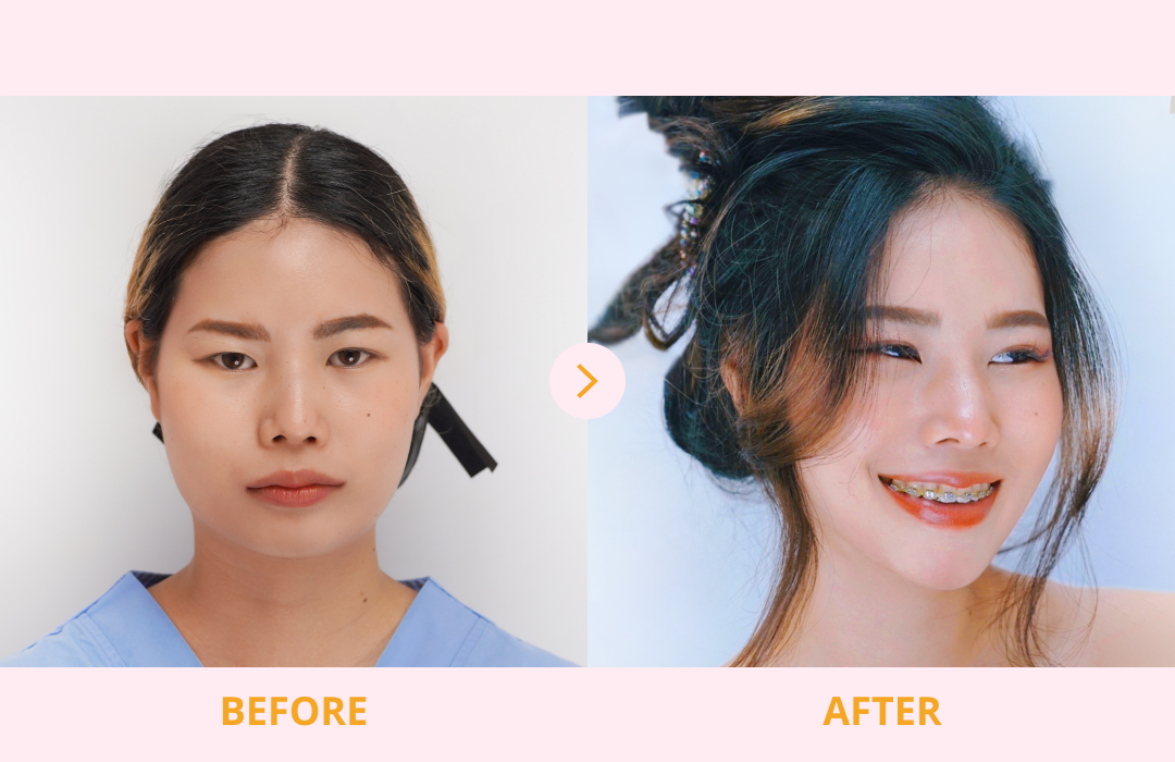 Chin_Surgery