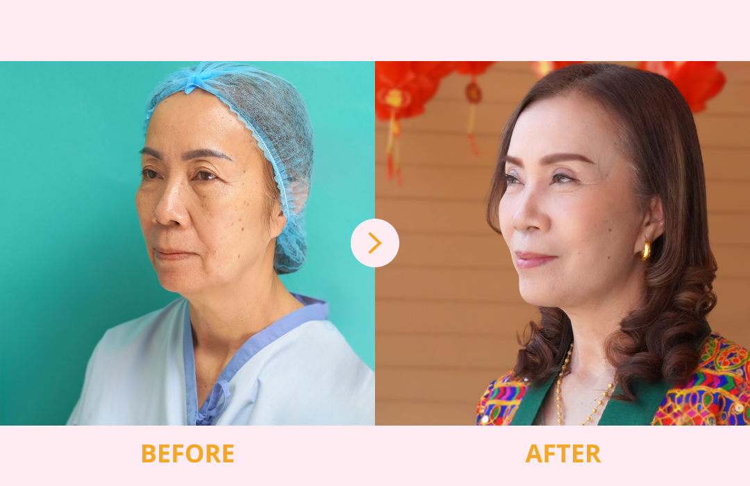 Face_Lift
