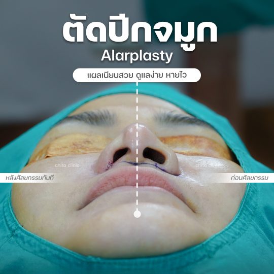 ตัดปีกจมูก ตัดปีกจมูก